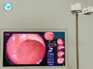 Ca nội soi tiêu hóa do các Bác sĩ Bệnh viện Hữu Nghị thực hiện